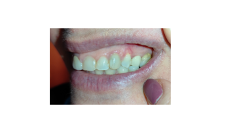 dopo lo sbiancamento professionale dopo lo sbiancamento professionale