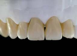 PONTE MONOLITICO IN ZIRCONIA