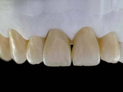 zirconia monolitico multilayer