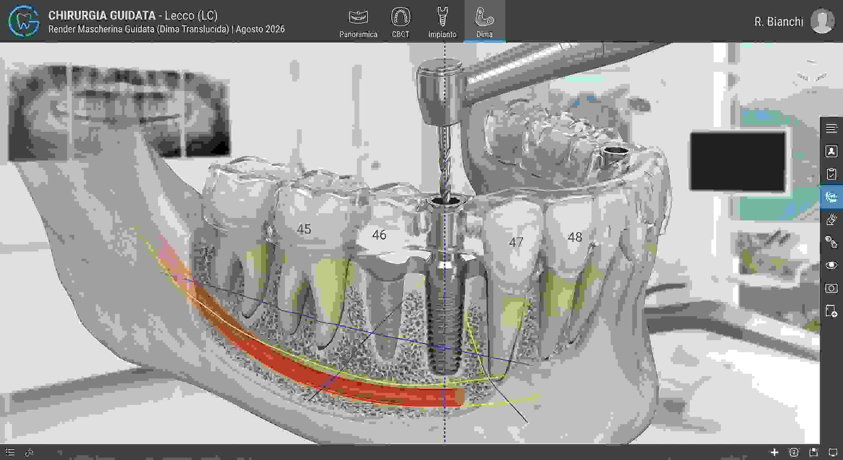 La Chirurgia Implantare Guidata: Precisione Tecnologica al Servizio dell'Esperienza Medica