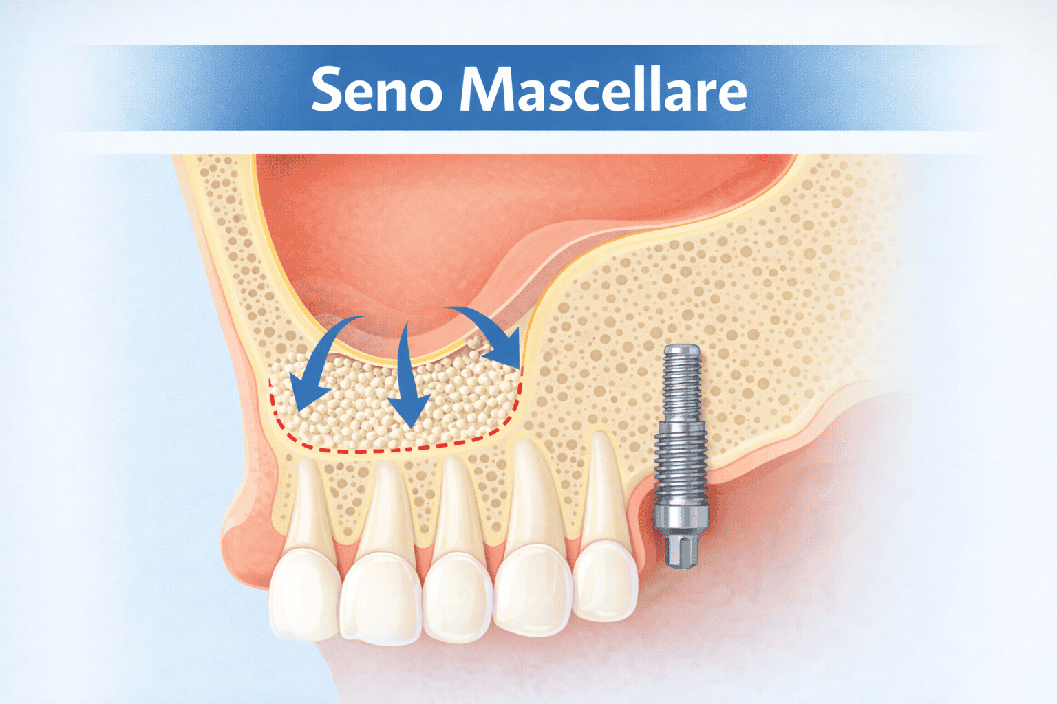 Ricostruzione ossea e rialzo del seno mascellare: la verità sui tempi e sul percorso clinico