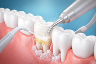 igiene dentale igiene dentale