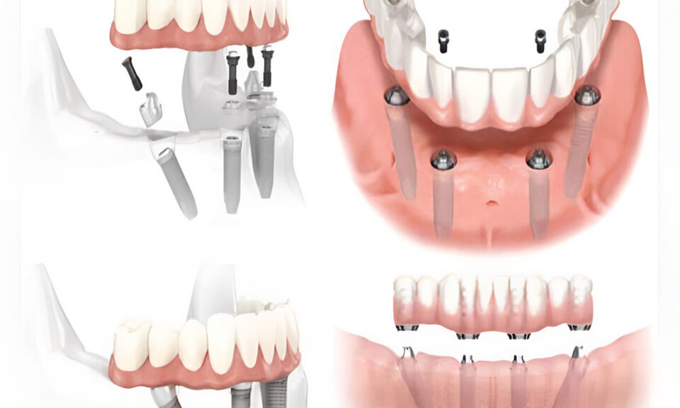 impianti-all-on-four.jpeg
