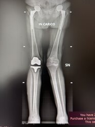 Radiografia degli arti inferiori sotto carico dopo protesi di ginocchio