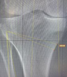 Planning preoperatorio di osteotomia correttiva del ginocchio su radiografia
