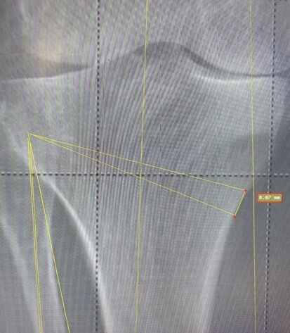 planning osteotomia.jpeg planning osteotomia.jpeg