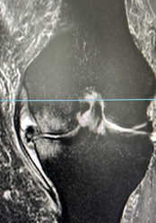 Risonanza magnetica del ginocchio per la diagnosi di lesioni meniscali e legamentose